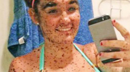 Teen With Hundreds Of Mole-Like Birthmarks Sticks It to Bullies By Posing In Bikini