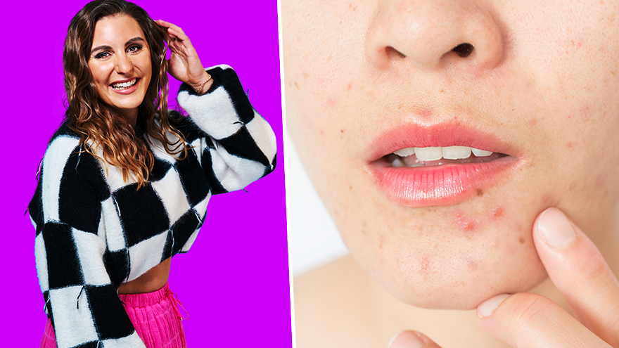 Georgia Burt talks about her struggles with acne growing up and shares valuable tips on what could help