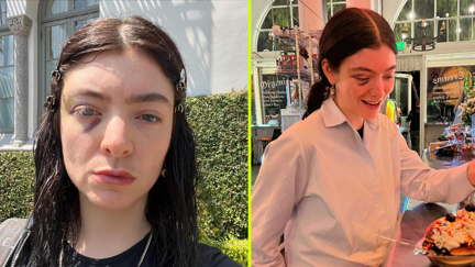 Lorde's black eye